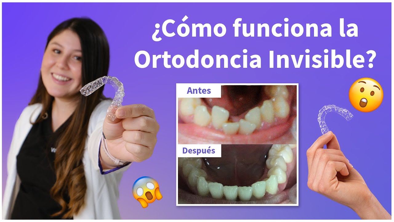 ¿Cómo funciona la ortodoncia invisible?