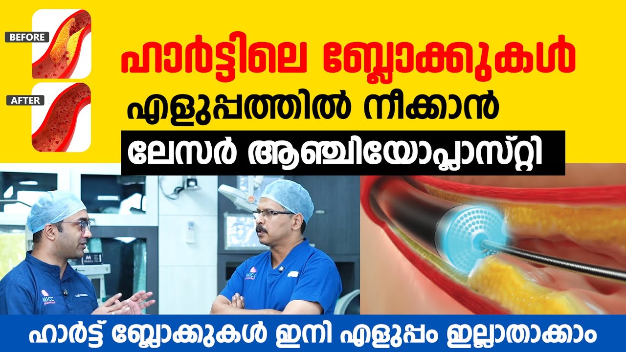ഹാർട്ടിലെ ബ്ലോക്കുകൾ എളുപ്പത്തിൽ നീക്കാൻ ലേസർ ആഞ്ചിയോപ്ലാസ്റ്റി | Laser Angioplasty Malayalam