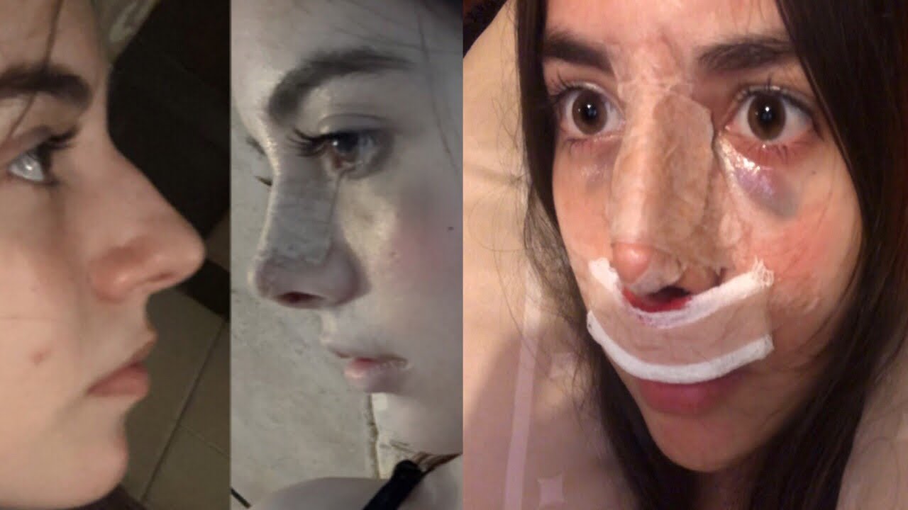 ME OPERE LA NARIZ // ¿CUANTO ME COSTO? ¿ME DESPERTE A MITAD DE CIRUGÍA?