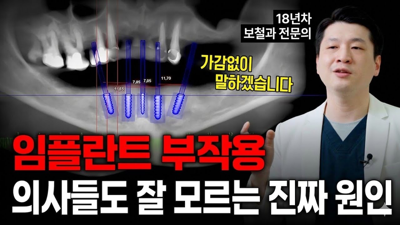 치과의사들도 잘 모르는 임플란트 부작용, 보철과 전문의로서 알려드립니다 #군포임플란트 #군포치과