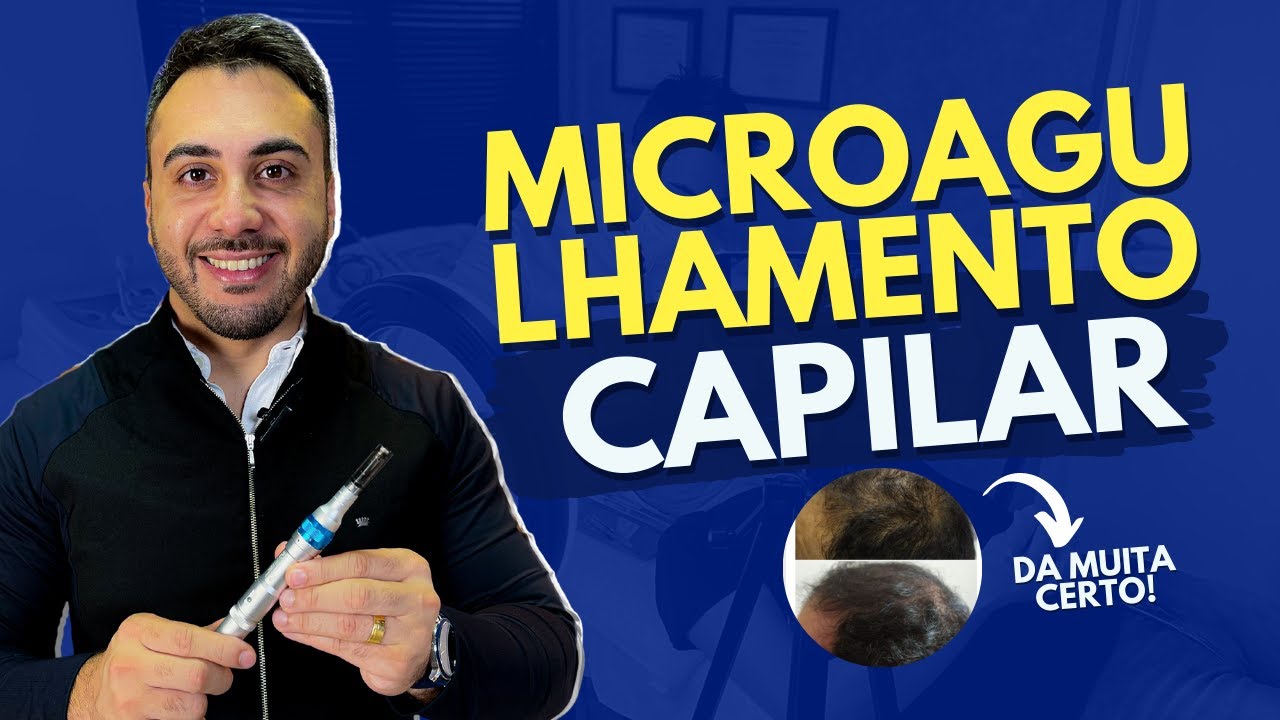AULA PRÁTICA CALVICIE FEMINA - PROTOCOLO DE MICROAGULHAMENTO CAPILAR