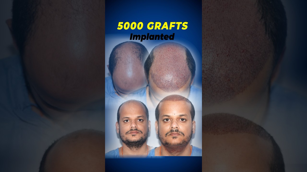 Grade 6 Baldness Transformed with 5000 Grafts | Hair Transplant by Dr. Suneet Soni