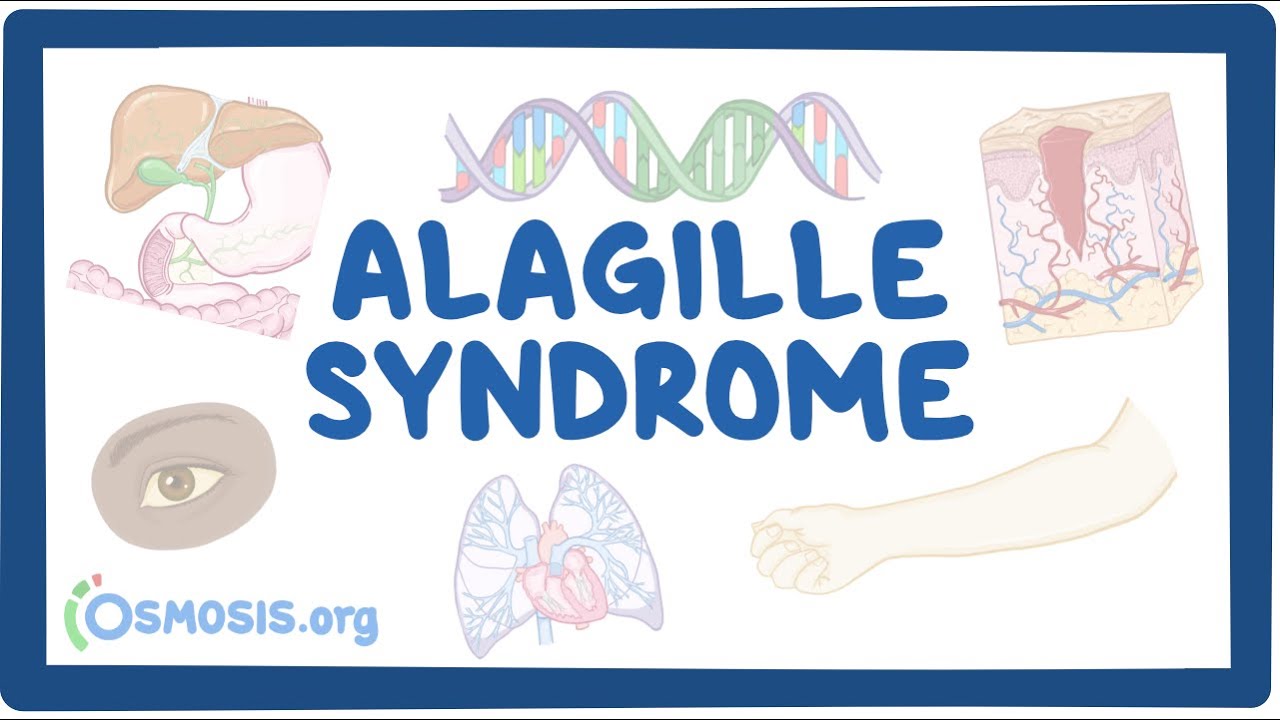 Alagille Syndrome- causes, symptoms, diagnosis, treatment, pathology