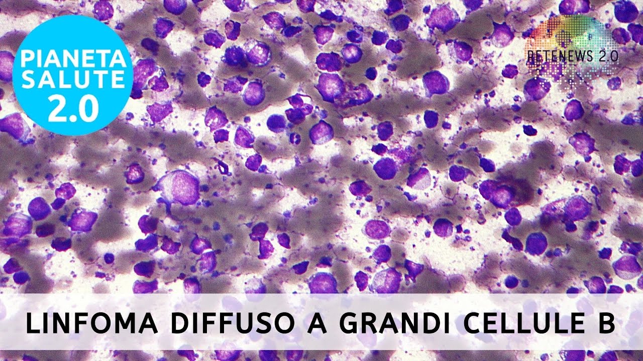 Nuove Speranze nel Trattamento del Linfoma Diffuso a Grandi Cellule B: EMA approva Tafasitamab
