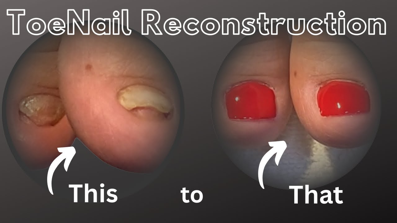 Toenail Reconstruction with NanoFlex by Fuzion