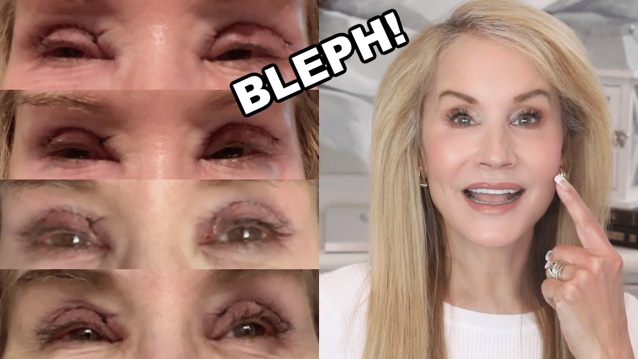 MY EYELID SURGERY! | FIRST TWO WEEKS OF RECOVERY VIDEO DIARY