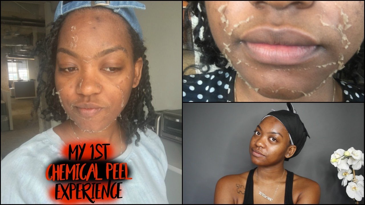 Chemical Peel Experience #1 | How I removed my dark spots #darkspotremoval