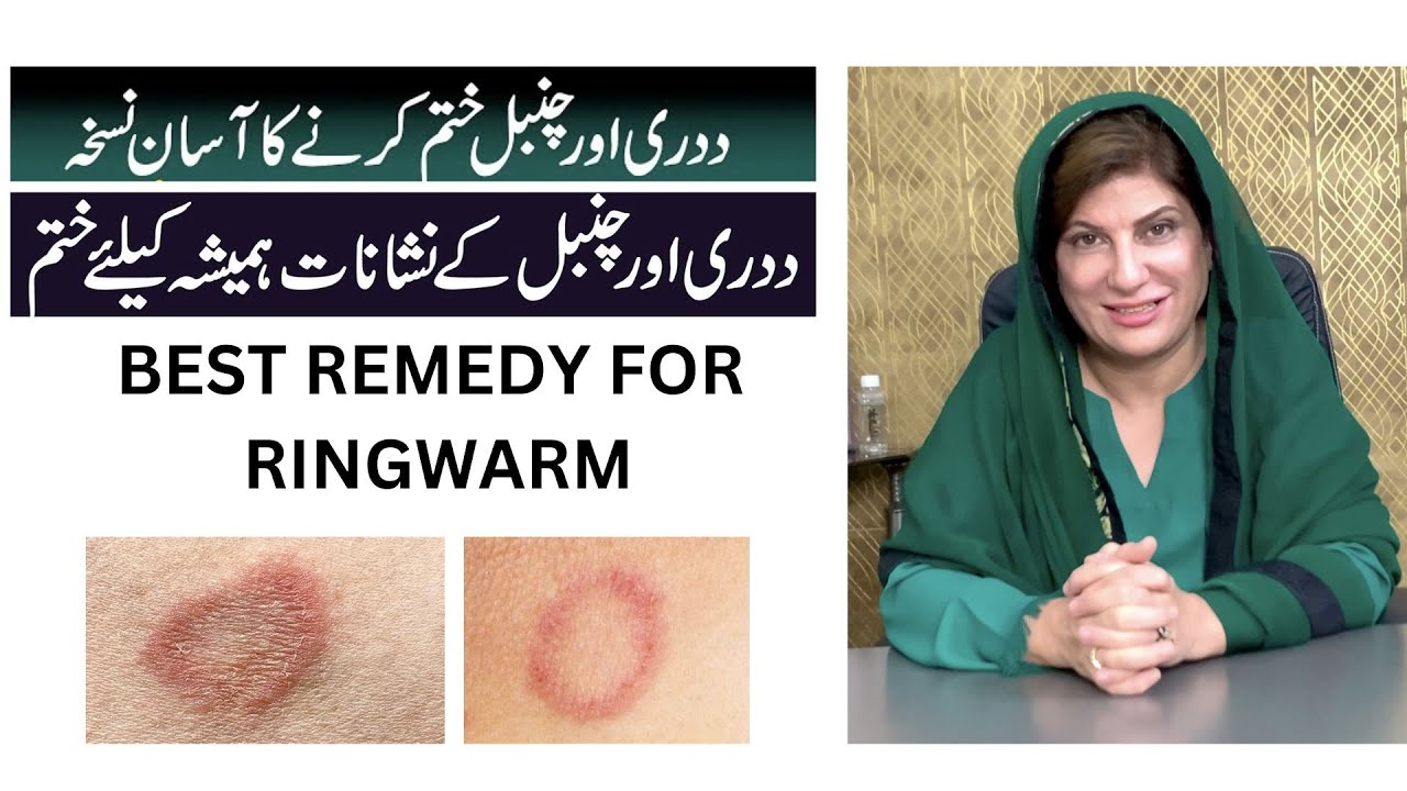 Ringworm infection | Ringworm home treatment | daad ka ilaj | daad treatment | by Dr.Bilquis
