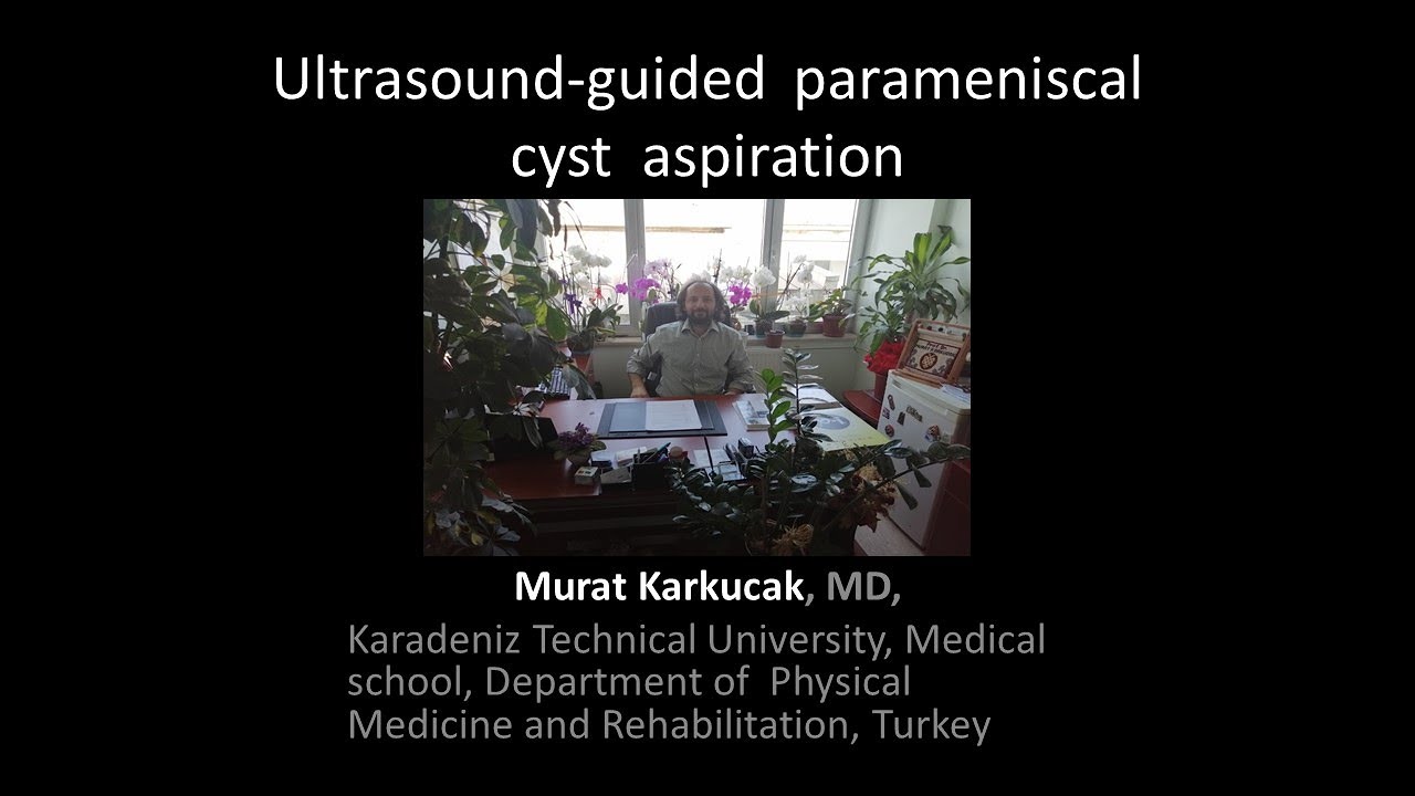 Ultrasound-guided  parameniscal cyst&nbsp; aspiration by Prof Murat Karkucak MD
