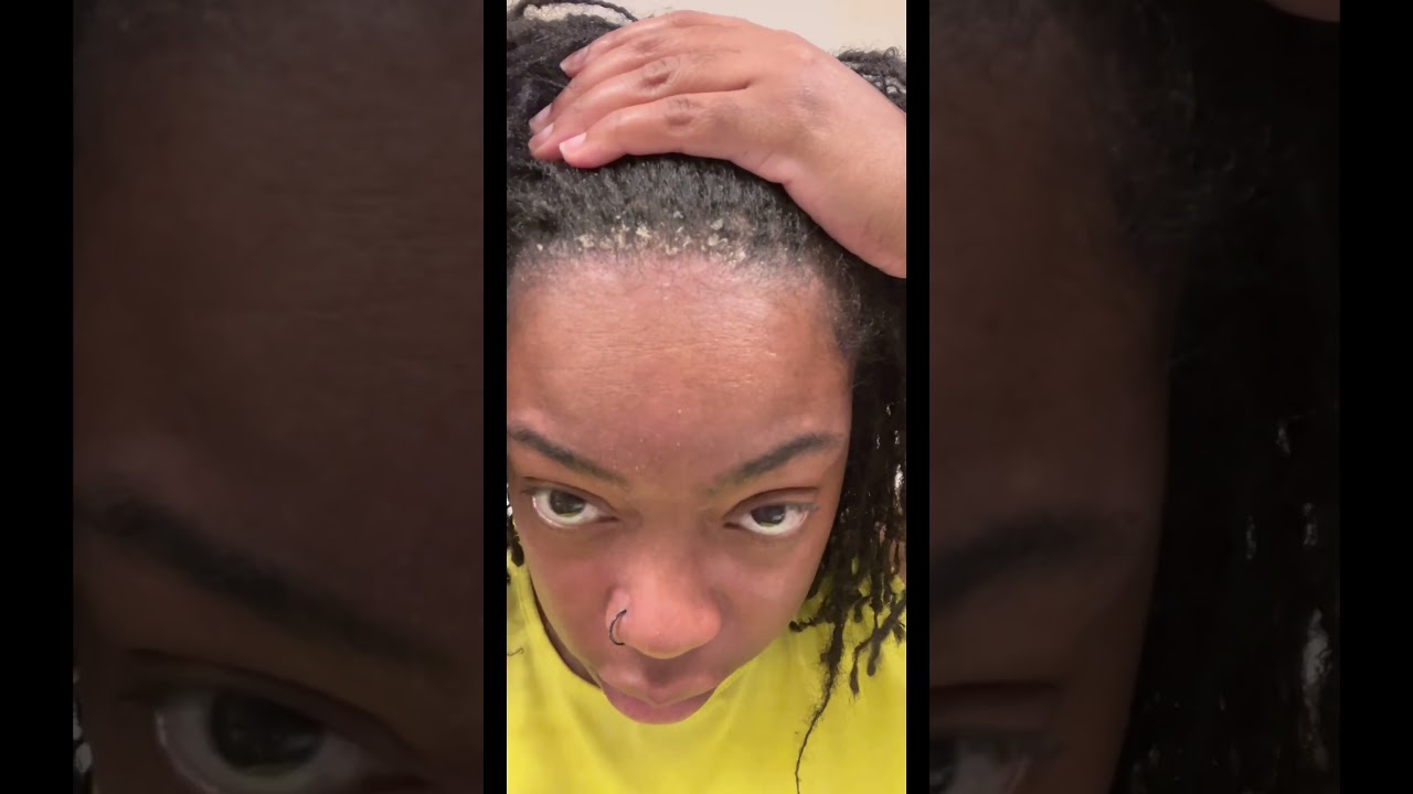 Scratching dry itchy flakes #asmr #dandruff #mentalhealth
