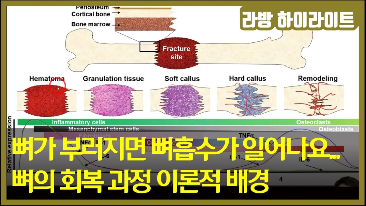 뼈가 부러지면 뼈흡수가 일어나요 / 뼈의 회복 과정