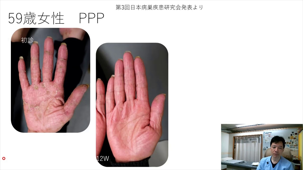 【医師解説】掌蹠膿疱症の治療を通して考える「ら」と「せ」じゃ大違い！【もう一度言う】