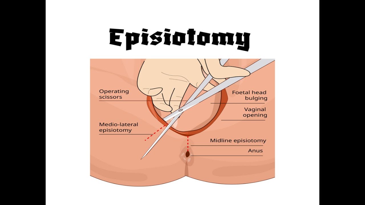 Episiotomy | Perineotomy | Easy to learn | With notes | In Hindi