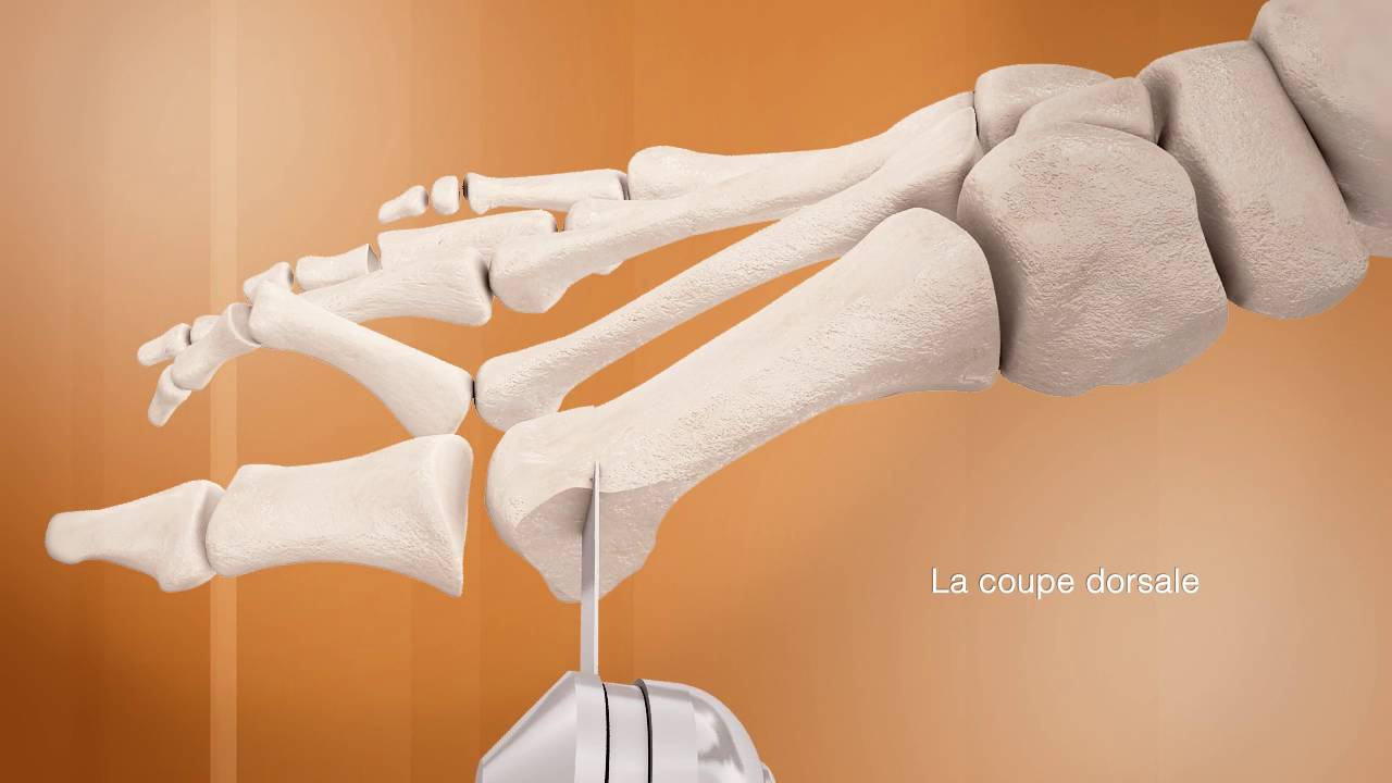 Dr. Coillard | Dr. Boublil | Dr. Grisard - L'ostéotomie de SCARF