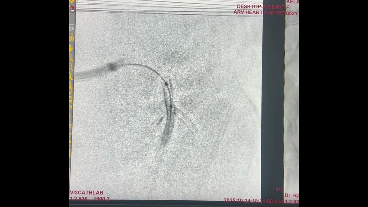 LAD/D1 Bifurcation Stenting ( Mini crush technique)
