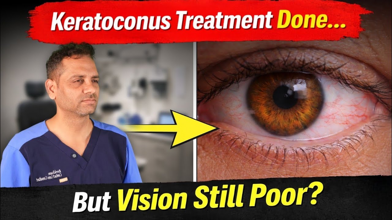Keratoconus: Treatment vs Vision Explained