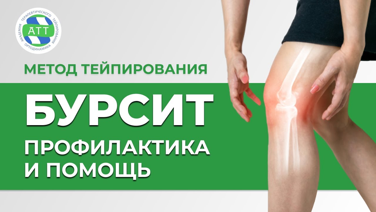✅ Бурсит коленного сустава | Тейпирование колена | Бурсит лечение