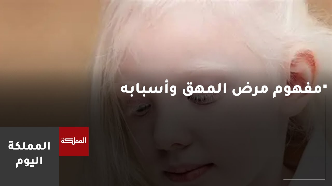 مفهوم مرض المهق وأسبابه