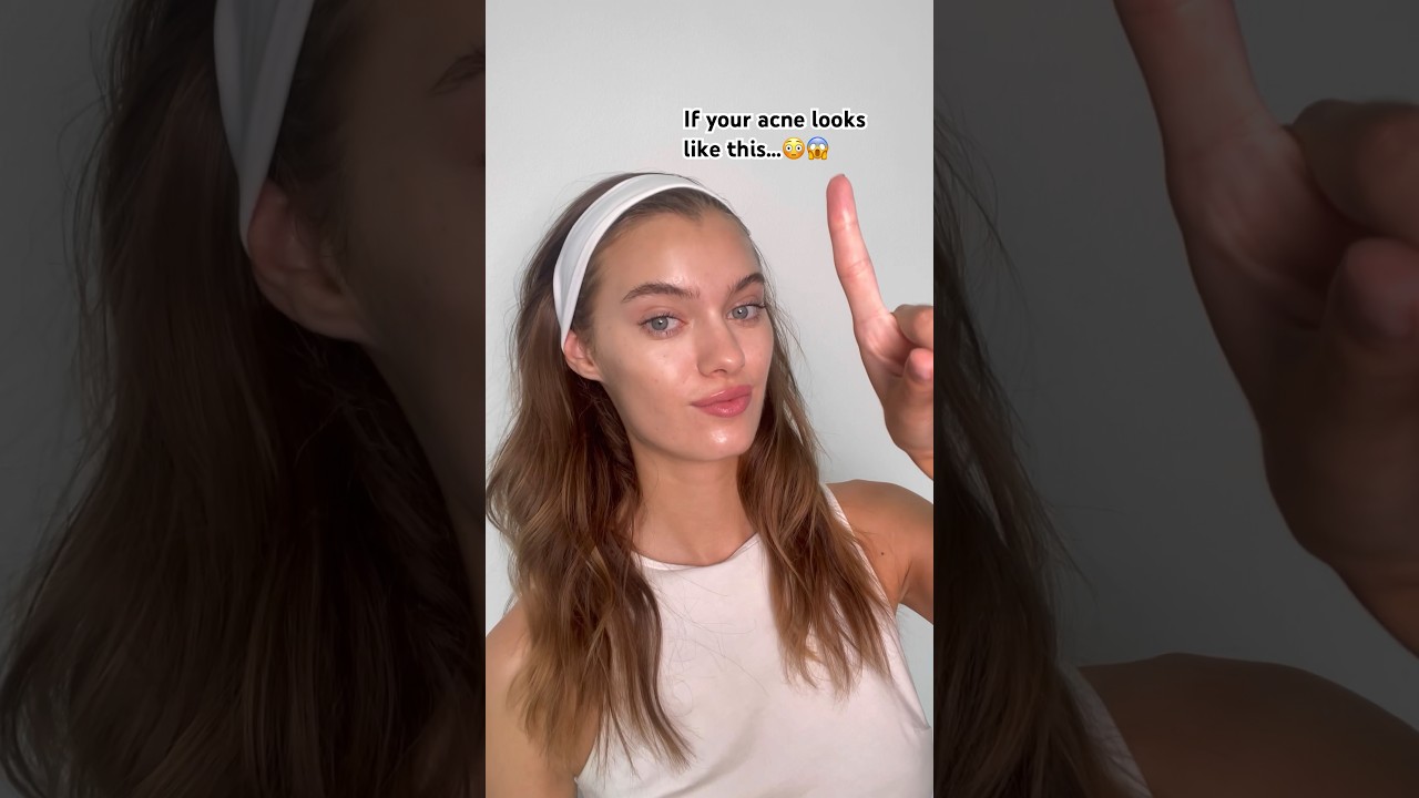 Acne on hairline😳, are you sure that’s not what causes it?🙌🏻