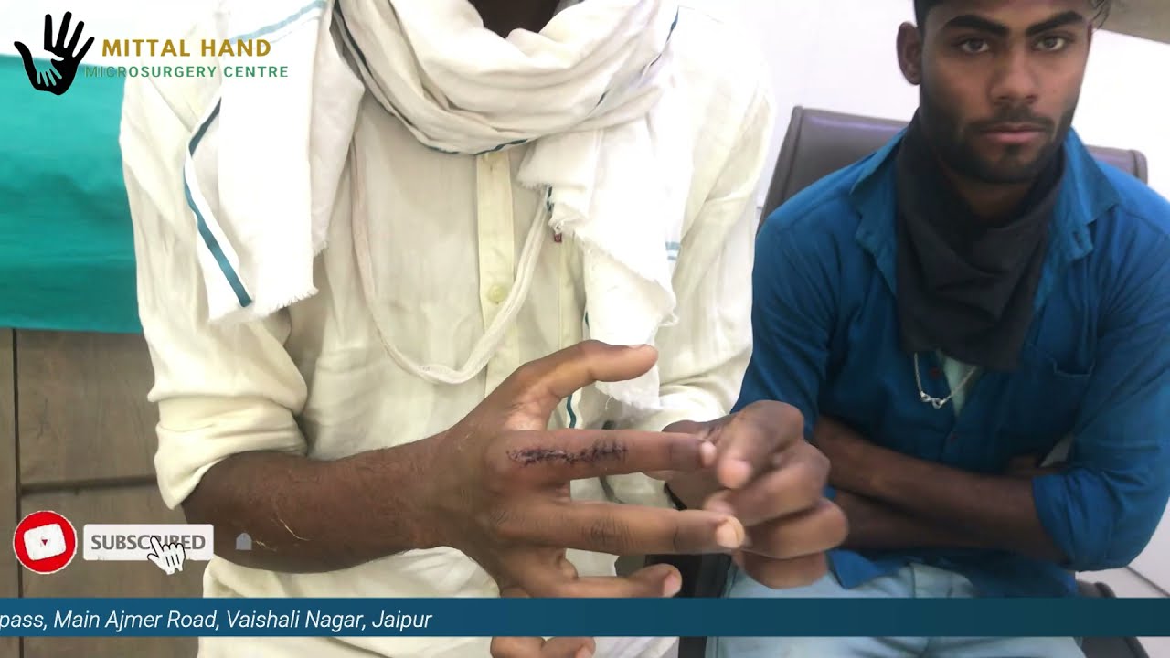 finger Movement Block Finger stiffness हाथ की उँगलियाँ या जॉइंट जाम |Trigger Finger Release Surgery