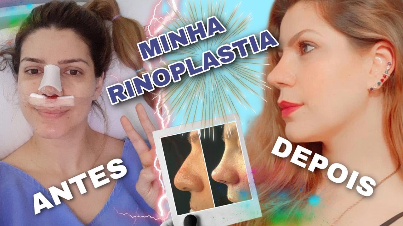 MINHA RINOPLASTIA - ANTES E DEPOIS ( CONTO TUDO).