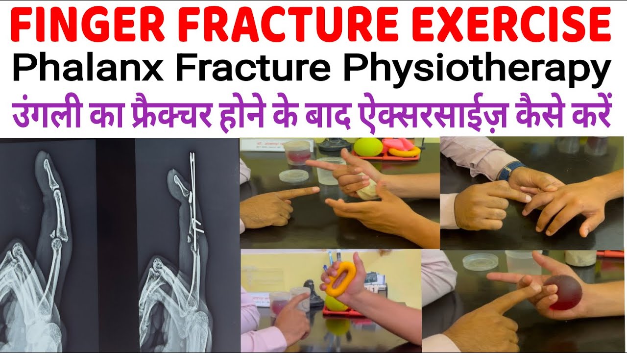 Finger Fracture Exercises | Phalanx Fracture Exercises | Finger Fracture Physiotherapy Exercise