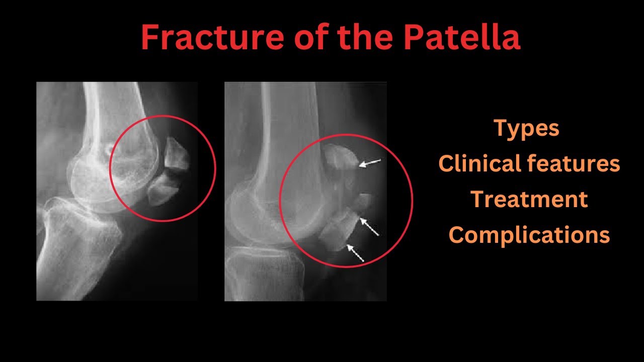 Fracture of the Patella: Types, clinical features, treatment & complications (Complete Guide)