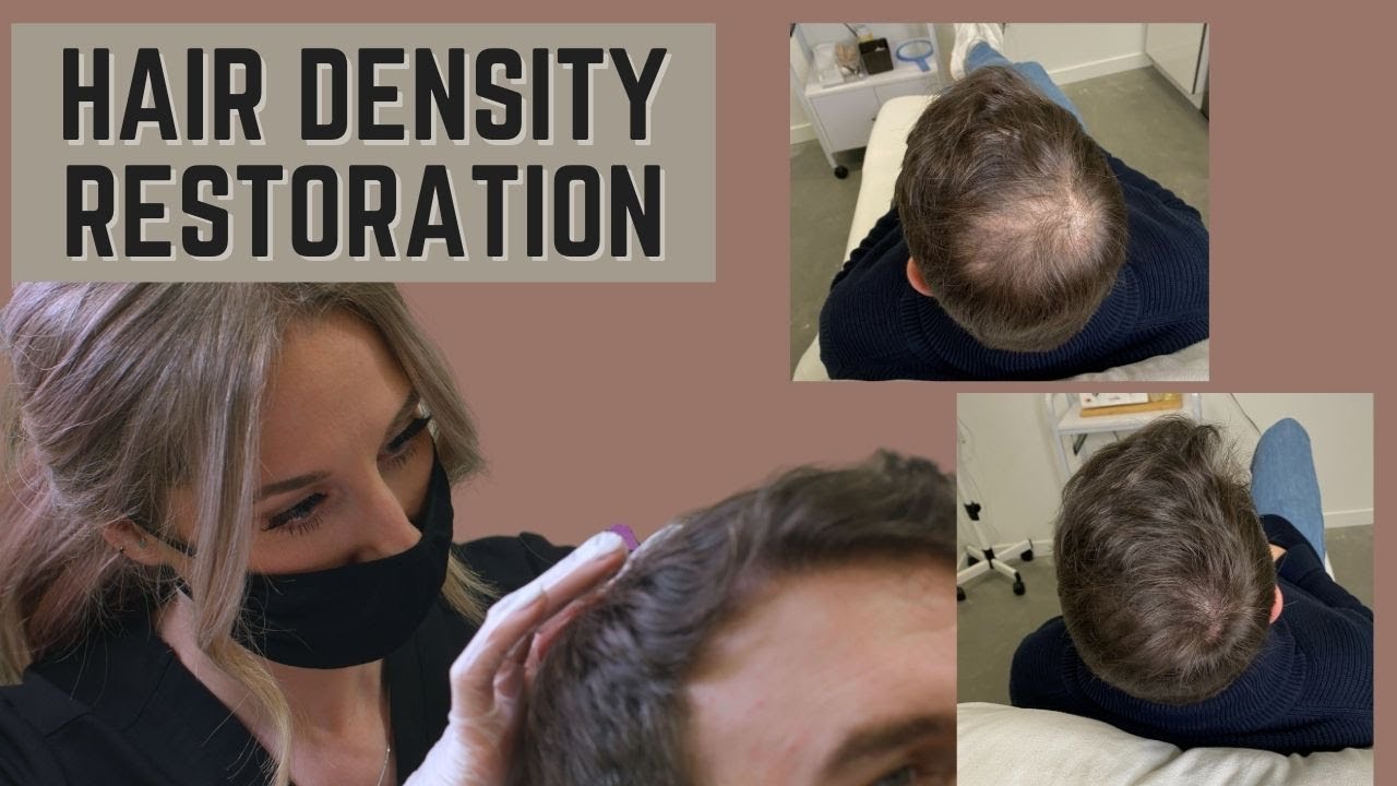 Now Offered at Fluid Spa - Scalp Micropigmentation