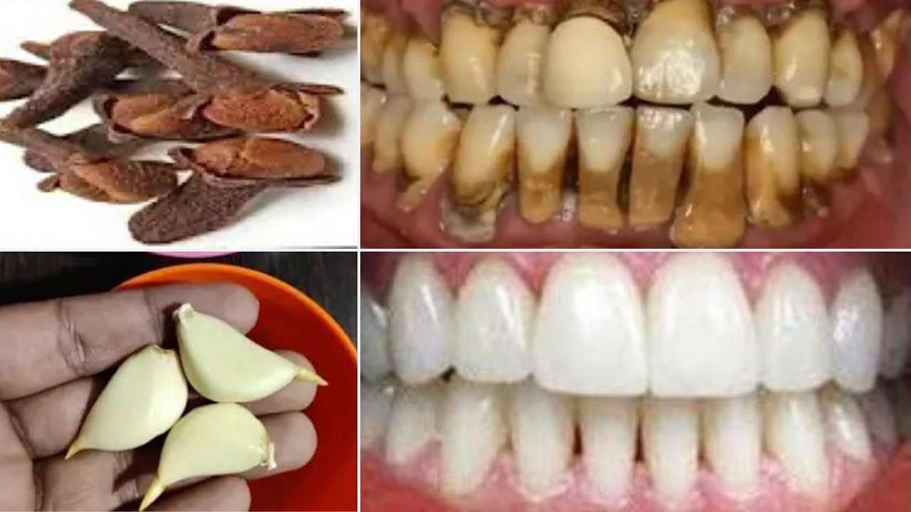 Blanchissez vos dents sales &agrave; la maison en 5 minutes. blanchiment des dents tr&egrave;s efficace naturellem