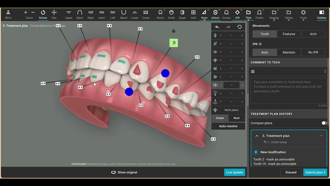 3D Controls: How to Close Upper Anterior Spaces without Premature Contacts