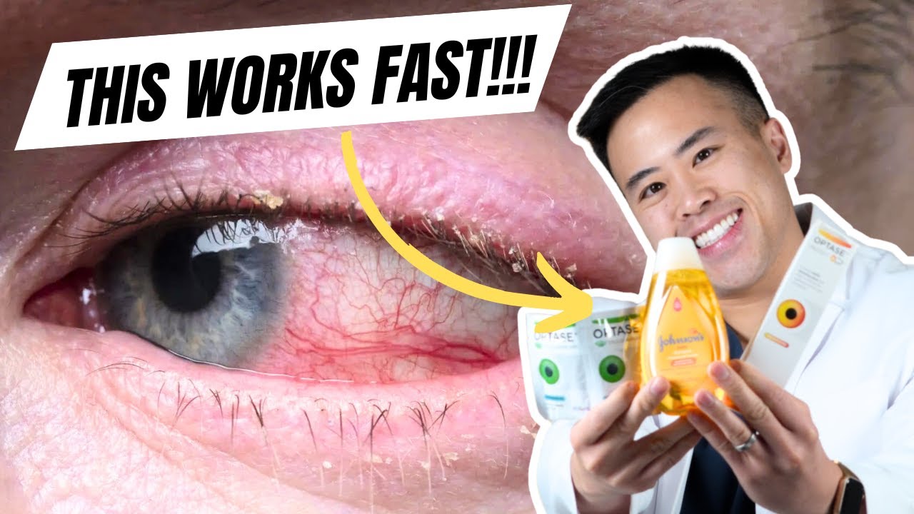 The Best OTC Treatments for Blepharitis