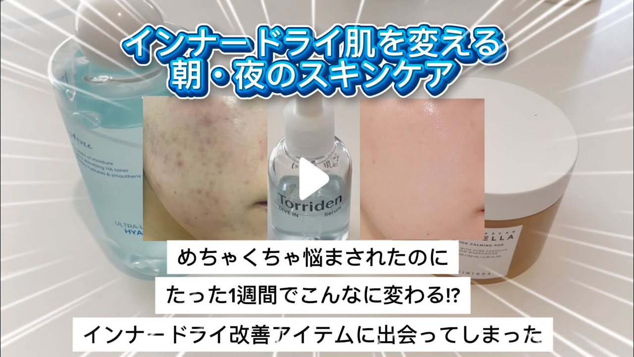 【肌荒れ脱出】悩みすぎたインナードライ肌、劇的に改善したスキンケア公開！