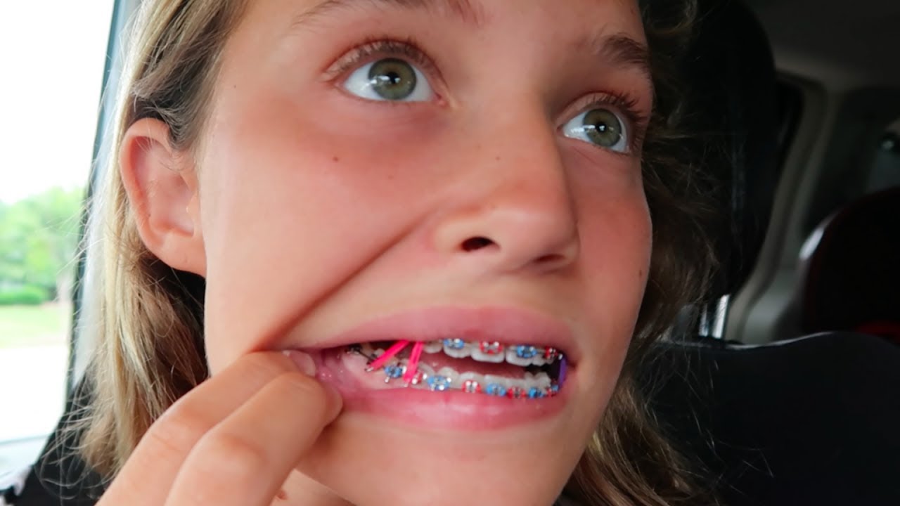 BRACES ADJUSTMENT! MAJOR CHANGES!