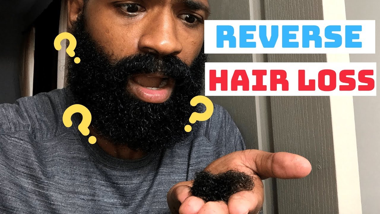 How I REVERSED and STOPPED My Hair Loss | Black Men's Hair Loss