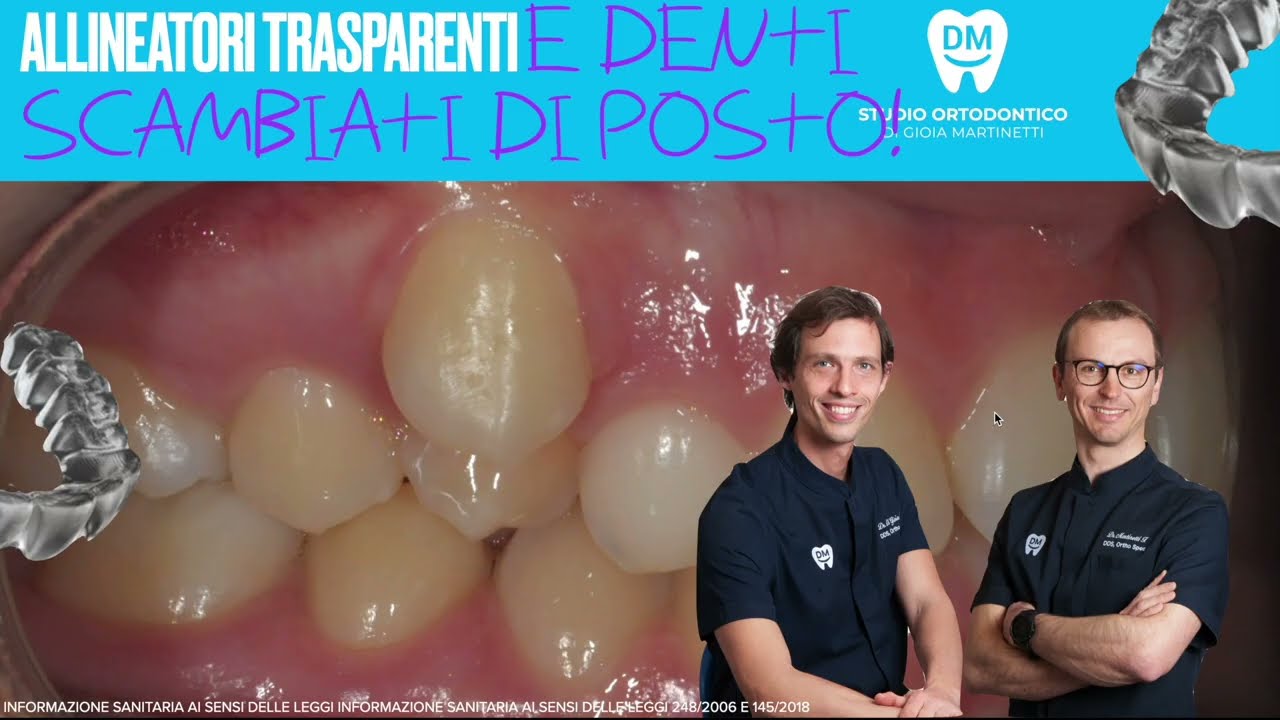 Allineatori mascherine trasparenti Denti scambiati di posto canino-premolare risolto con apparecchio