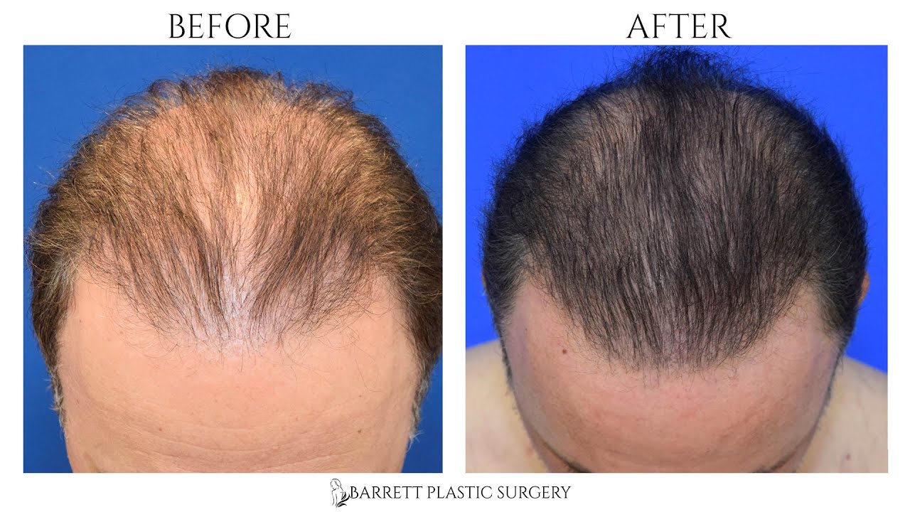 Platelet-Rich Plasma for Hair Loss | PRP Hair Restoration With Microneedling | Beverly Hills, CA