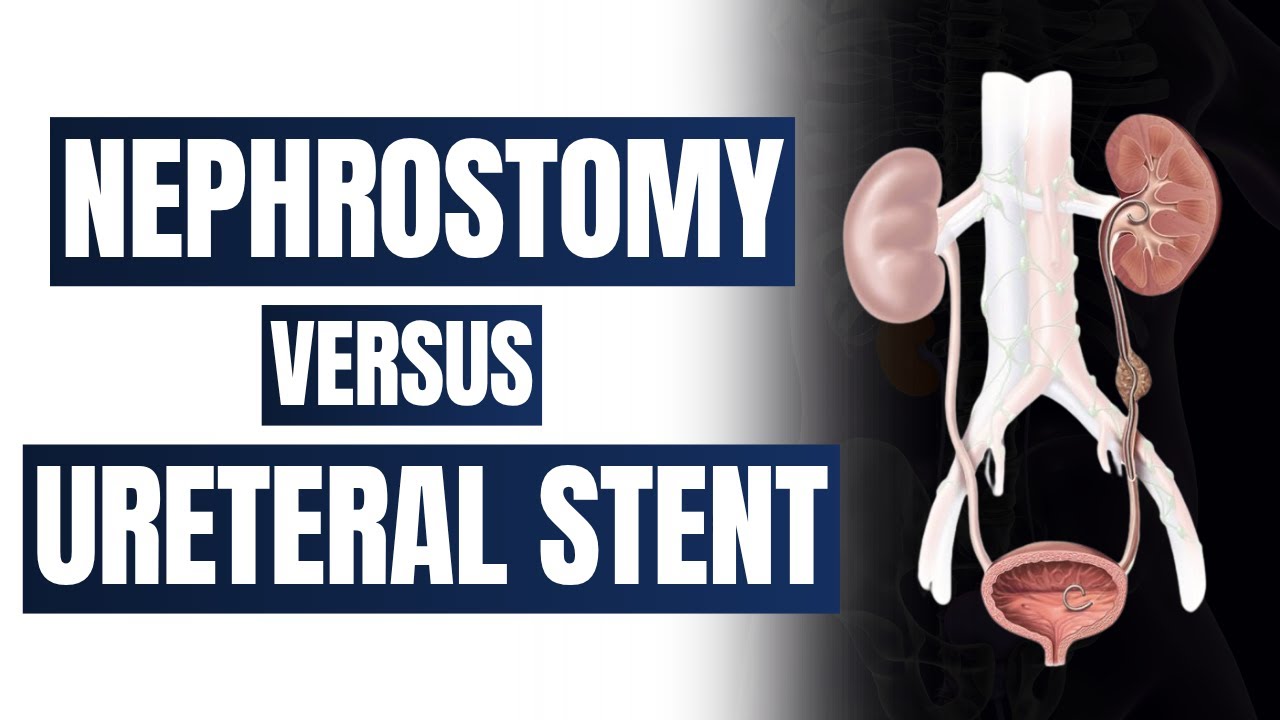 What are Double J stents, Nephrostomy tubes, and NU stents?