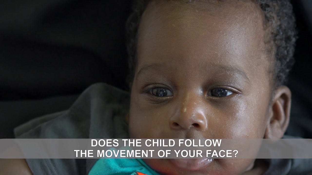 Checking the vision of a baby less than 6 months