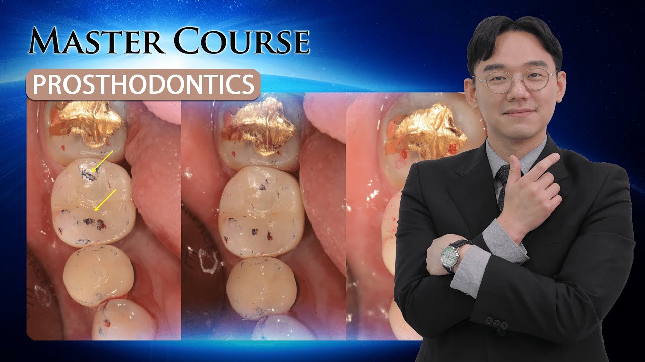 [Master Course - PROSTHODONTICS] Implant Prosthesis Setting & Occlusal Adjustmen