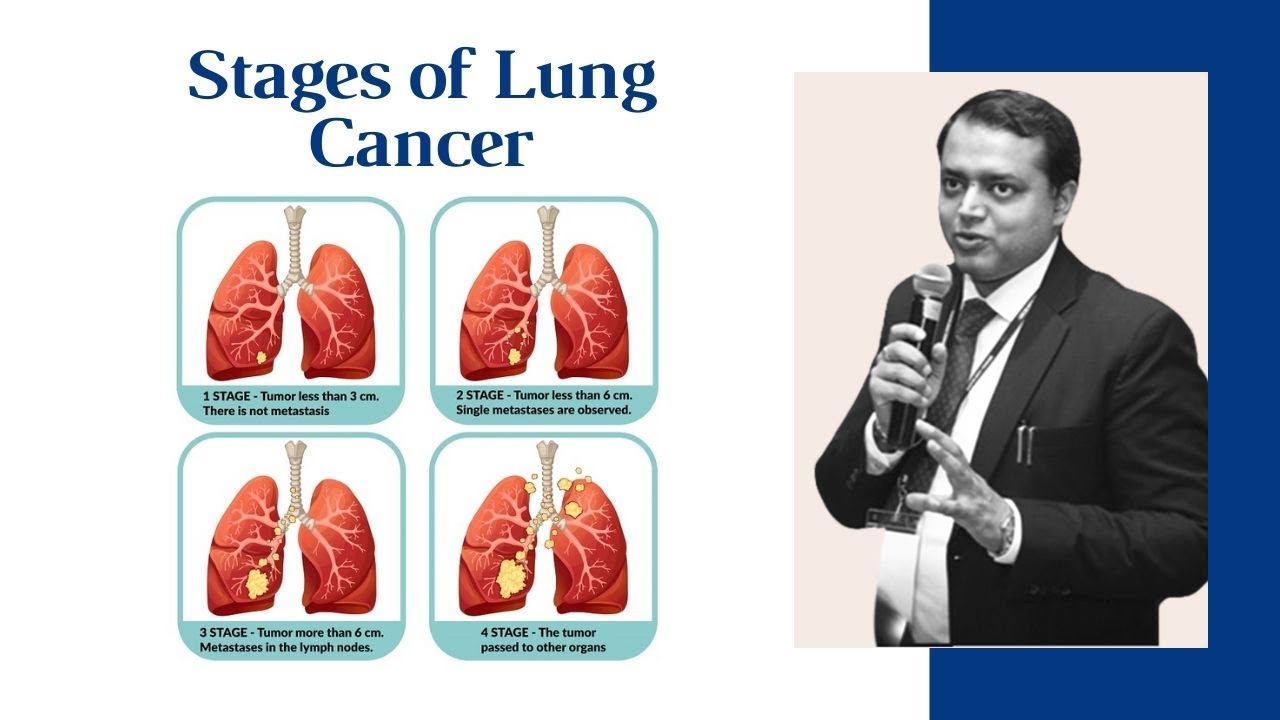 What are the Stages of Lung Cancer | Most Curable Stage of Lung Cancer | ft. Dr. Manish Singhal