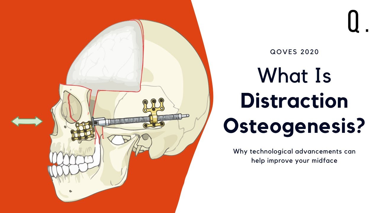 Can You Expand Your Midface After It's Done Growing? | Bone Lengthening Procedure