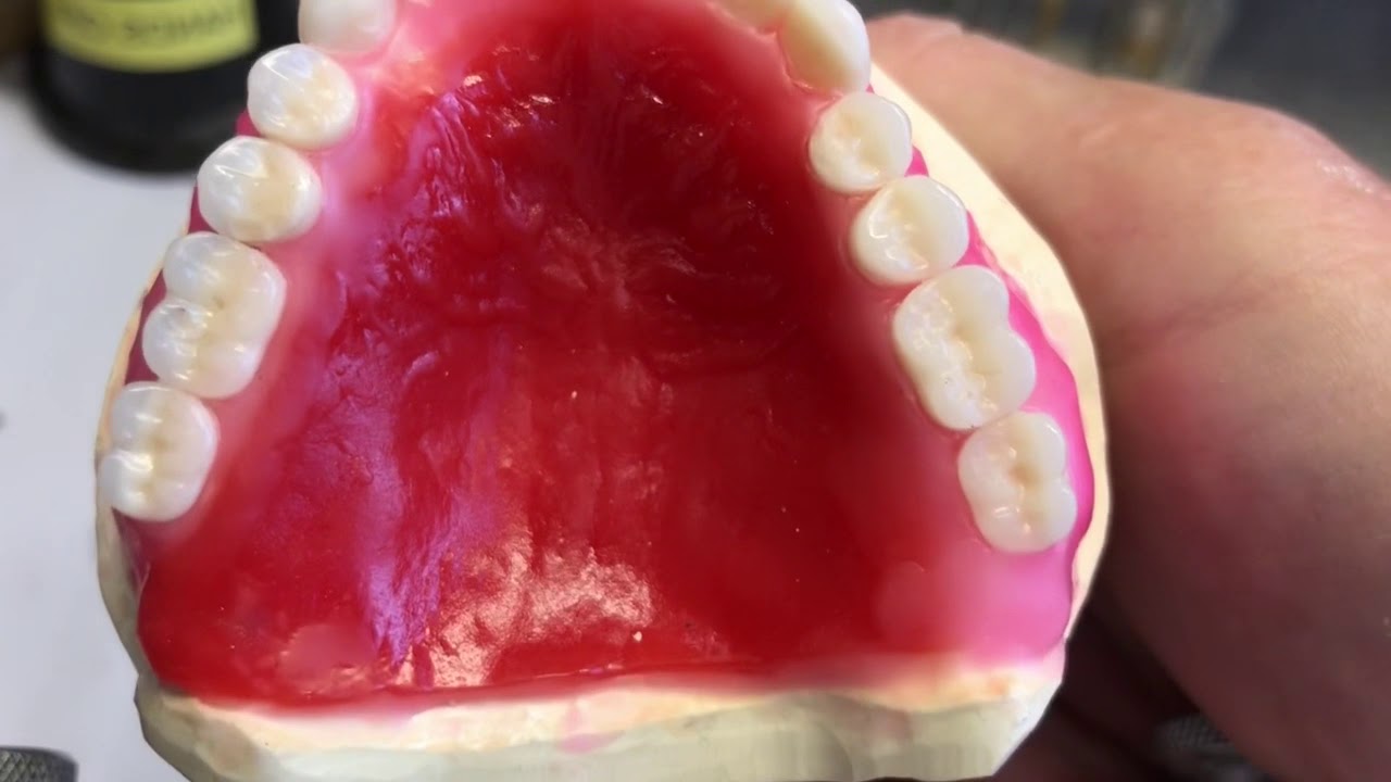 Immediate complete denture set-up overview with lab fabricated surgical guide