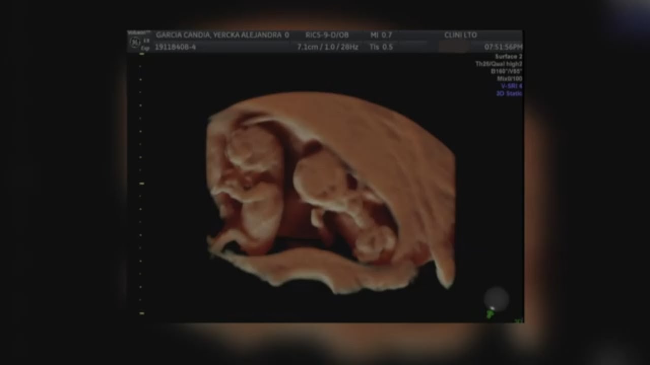Denver company invents new ultrasound using AI