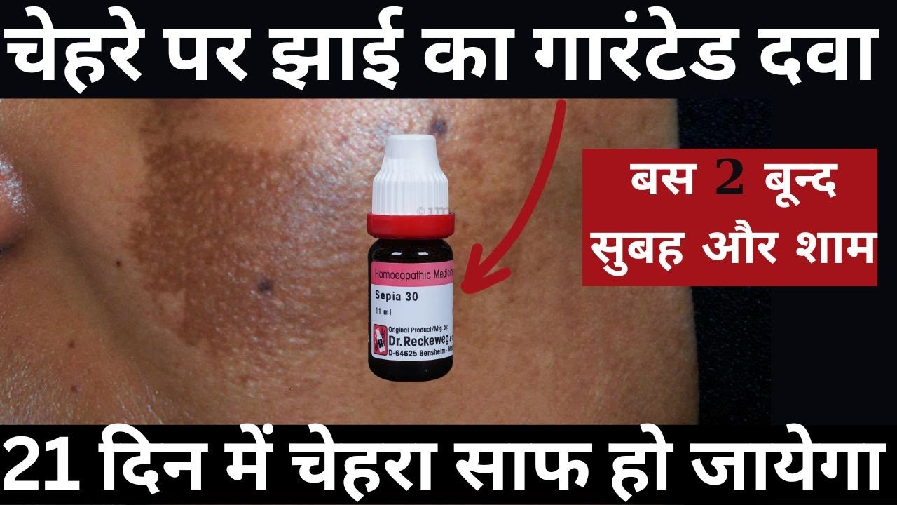 चेहरे की झाई ( मेलास्मा ) का कारण और होम्योपैथिक इलाज - Homeopathic Treatment For Melasma