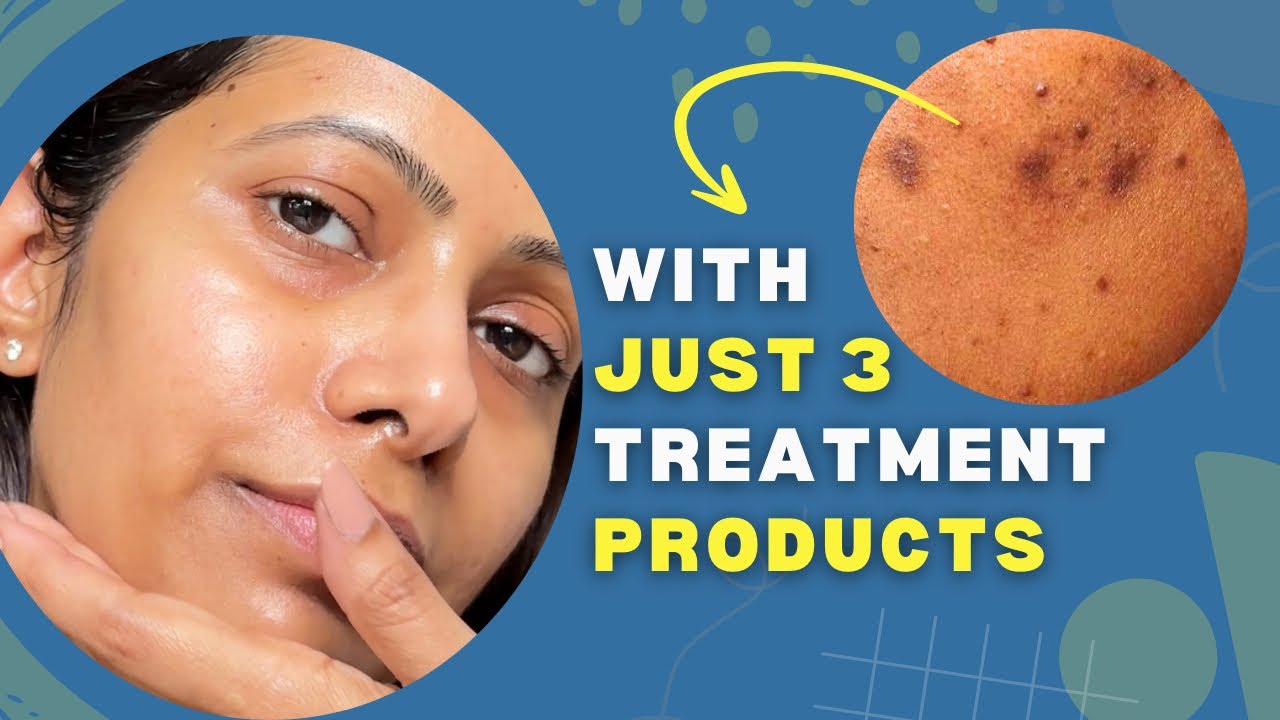 Only Skincare Products You Need to FADE stubborn BLACK brown acne marks spots on Face