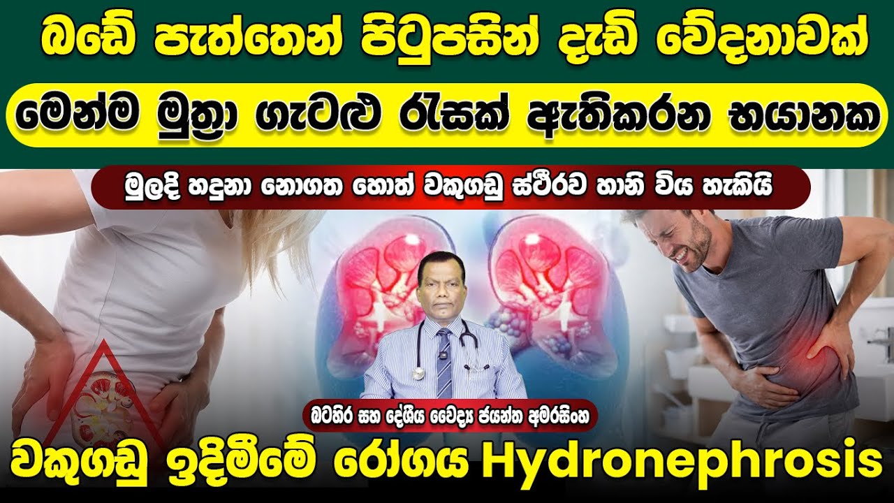 බඩේ පැත්තෙන්, පිටුපසින් දැඩි වේදනාවක් ඇතිවන, මුත්‍රා ගැටළු ඇතිකරන වකුගඩු ඉදිමීමේ රෝගය Hydronephrosis