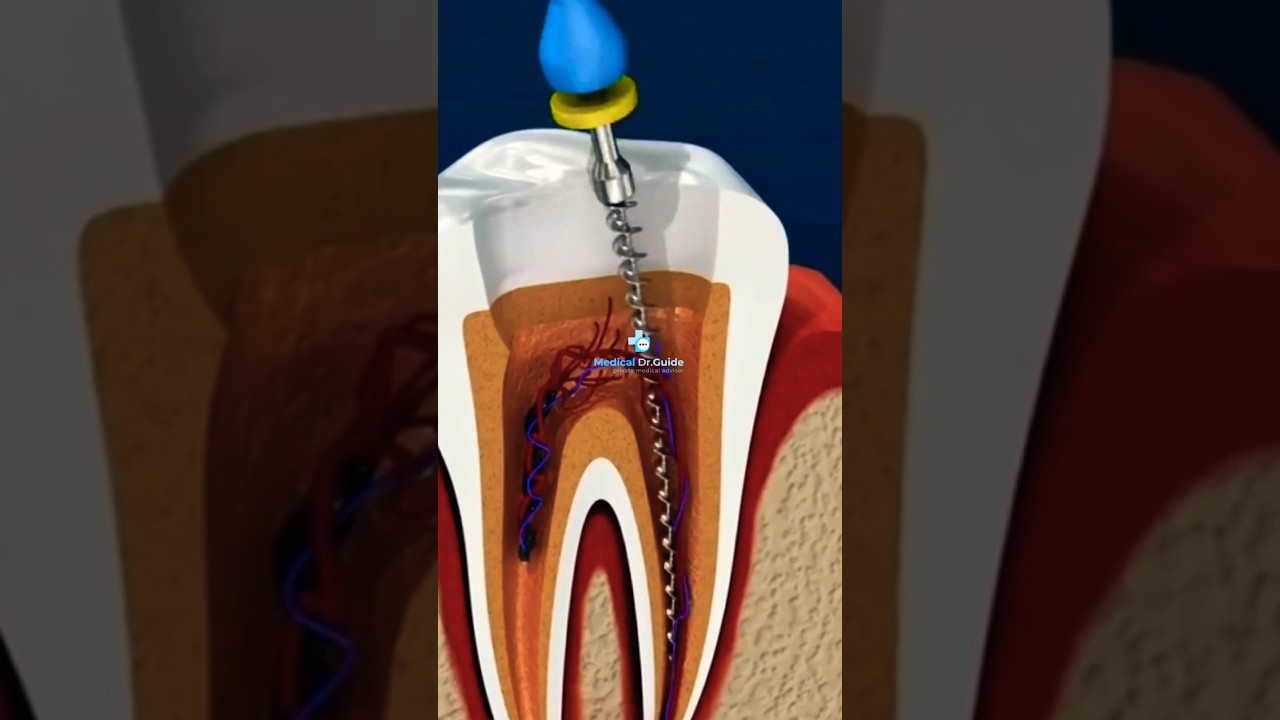 Zahnerhaltung durch Expertenhand: Die Kunst der Wurzelkanalbehandlung #medicaldrguide.com