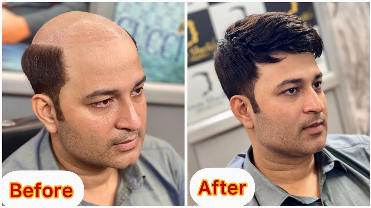 Hair Patch Center in Jaipur | Hair Patches For Mens | Call us 9625587340 |  Hair Patch | Hair Wig