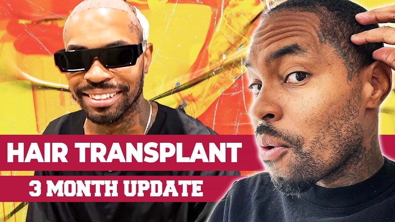 FUE HAIR TRANSPLANTAT 3 months  POST SURGERY!!