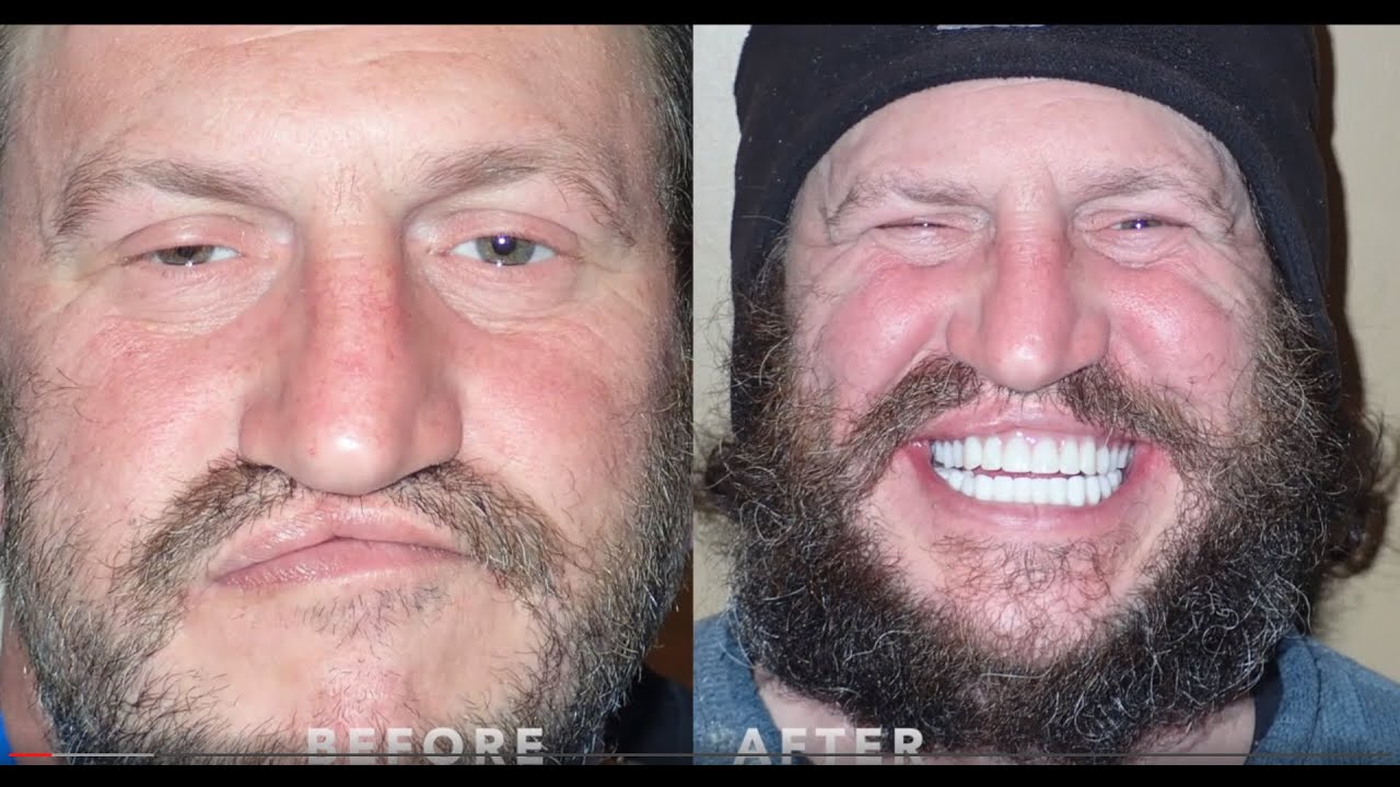 Teeth Now Buffalo vs Mini Implants